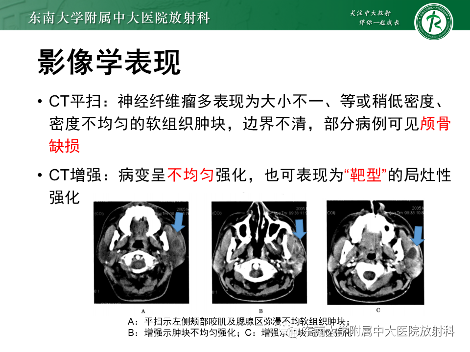 影像PPT - 【病例】颌面部恶性黑色素瘤1例MR影像-23
