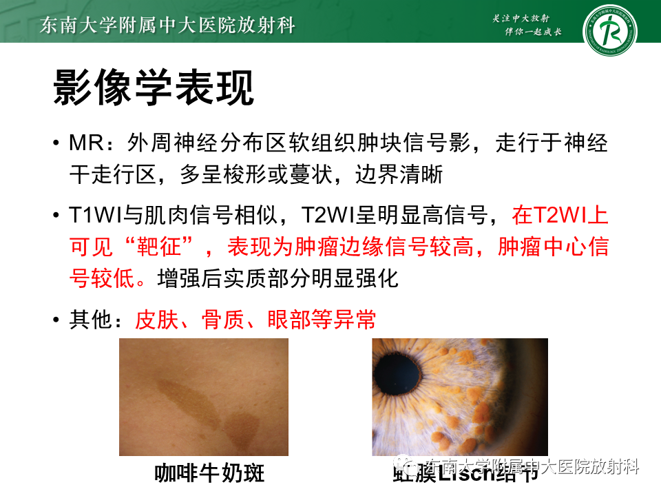 影像PPT - 【病例】颌面部恶性黑色素瘤1例MR影像-24