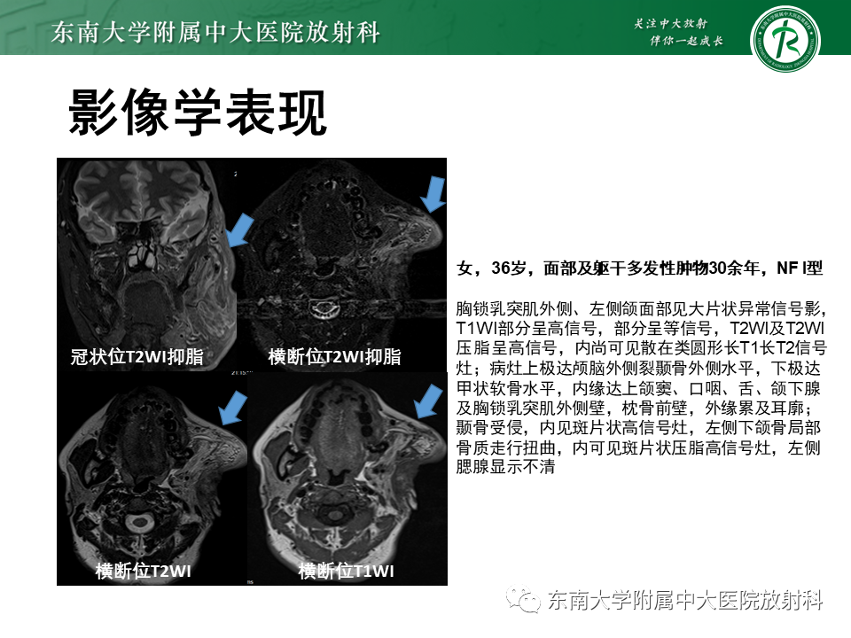 影像PPT - 【病例】颌面部恶性黑色素瘤1例MR影像-25