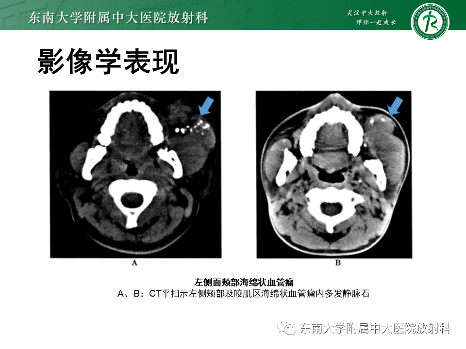 影像PPT - 【病例】颌面部恶性黑色素瘤1例MR影像-28