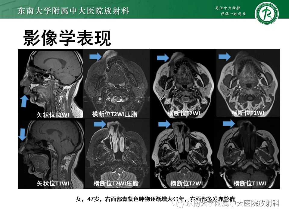 影像PPT - 【病例】颌面部恶性黑色素瘤1例MR影像-29