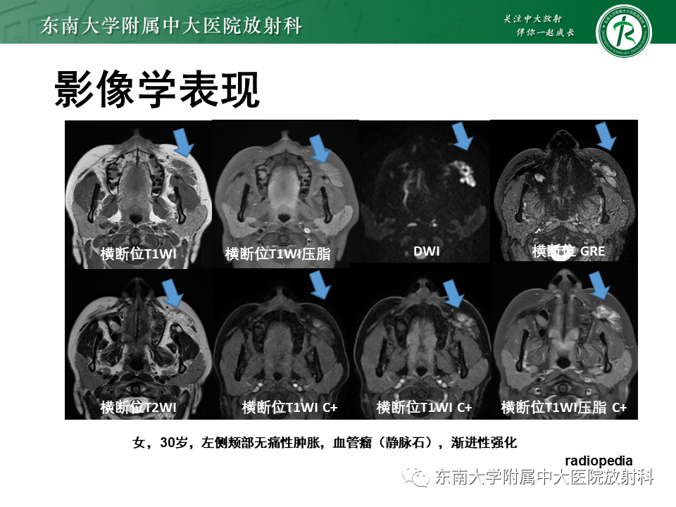 影像PPT - 【病例】颌面部恶性黑色素瘤1例MR影像-30