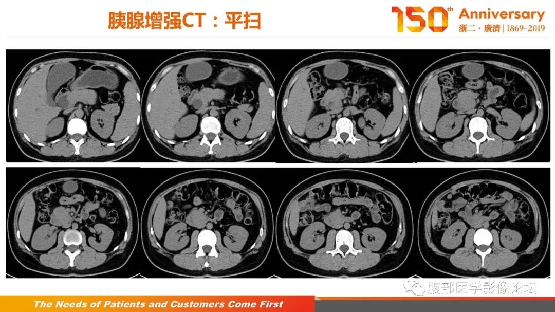 影像PPT - 【病例】胰腺、肝脏髓系肉瘤(绿色瘤)1例CT及MR影像-7 影像PPT - 【病例】胰腺、肝脏髓系肉瘤(绿色瘤)1例CT及MR影像-7