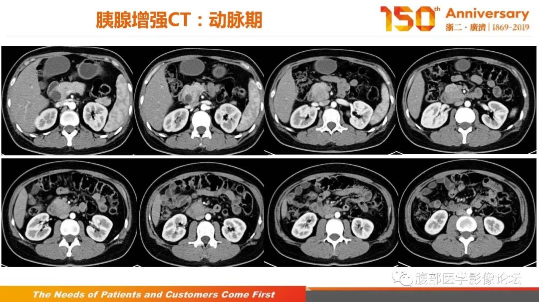 影像PPT - 【病例】胰腺、肝脏髓系肉瘤(绿色瘤)1例CT及MR影像-8 影像PPT - 【病例】胰腺、肝脏髓系肉瘤(绿色瘤)1例CT及MR影像-8