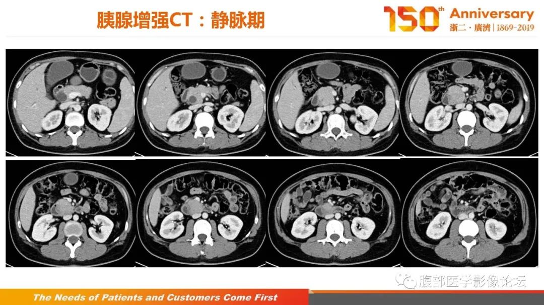 影像PPT - 【病例】胰腺、肝脏髓系肉瘤(绿色瘤)1例CT及MR影像-9 影像PPT - 【病例】胰腺、肝脏髓系肉瘤(绿色瘤)1例CT及MR影像-9