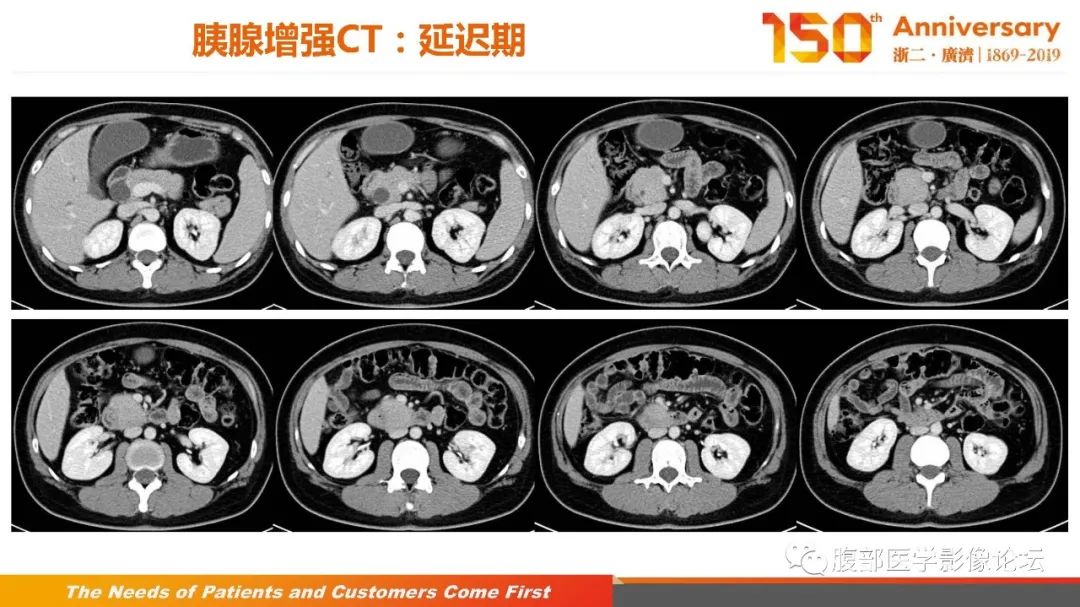 影像PPT - 【病例】胰腺、肝脏髓系肉瘤(绿色瘤)1例CT及MR影像-10 影像PPT - 【病例】胰腺、肝脏髓系肉瘤(绿色瘤)1例CT及MR影像-10