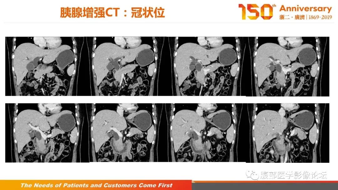 影像PPT - 【病例】胰腺、肝脏髓系肉瘤(绿色瘤)1例CT及MR影像-11 影像PPT - 【病例】胰腺、肝脏髓系肉瘤(绿色瘤)1例CT及MR影像-11