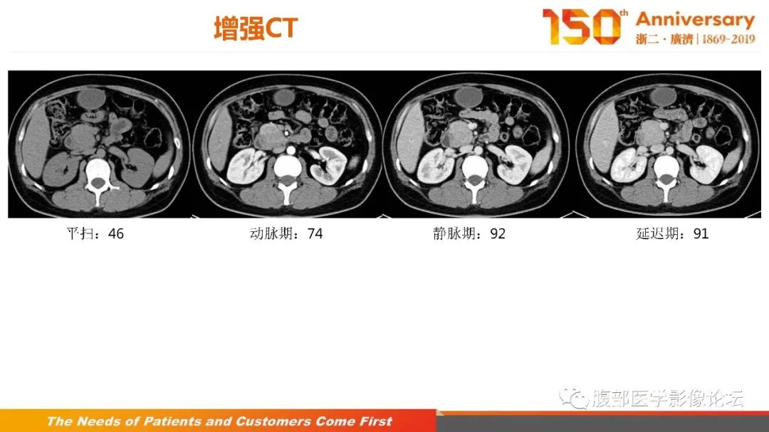 影像PPT - 【病例】胰腺、肝脏髓系肉瘤(绿色瘤)1例CT及MR影像-12 影像PPT - 【病例】胰腺、肝脏髓系肉瘤(绿色瘤)1例CT及MR影像-12