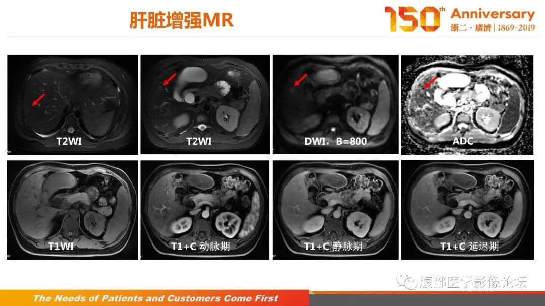 影像PPT - 【病例】胰腺、肝脏髓系肉瘤(绿色瘤)1例CT及MR影像-14 影像PPT - 【病例】胰腺、肝脏髓系肉瘤(绿色瘤)1例CT及MR影像-14