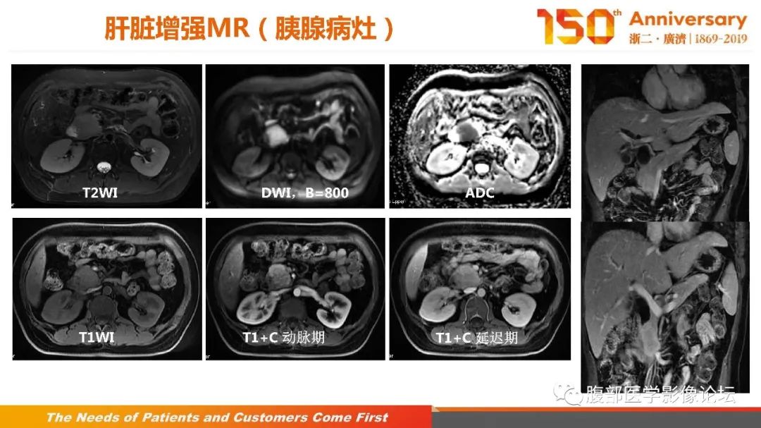 影像PPT - 【病例】胰腺、肝脏髓系肉瘤(绿色瘤)1例CT及MR影像-15 影像PPT - 【病例】胰腺、肝脏髓系肉瘤(绿色瘤)1例CT及MR影像-15