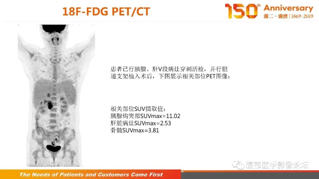 影像PPT - 【病例】胰腺、肝脏髓系肉瘤(绿色瘤)1例CT及MR影像-16 影像PPT - 【病例】胰腺、肝脏髓系肉瘤(绿色瘤)1例CT及MR影像-16