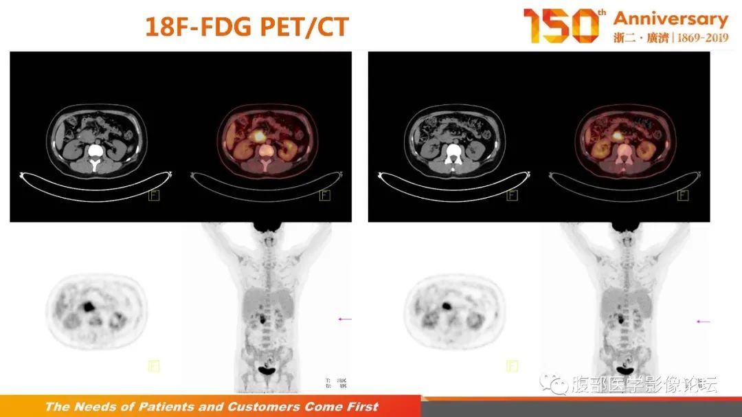 影像PPT - 【病例】胰腺、肝脏髓系肉瘤(绿色瘤)1例CT及MR影像-18 影像PPT - 【病例】胰腺、肝脏髓系肉瘤(绿色瘤)1例CT及MR影像-18