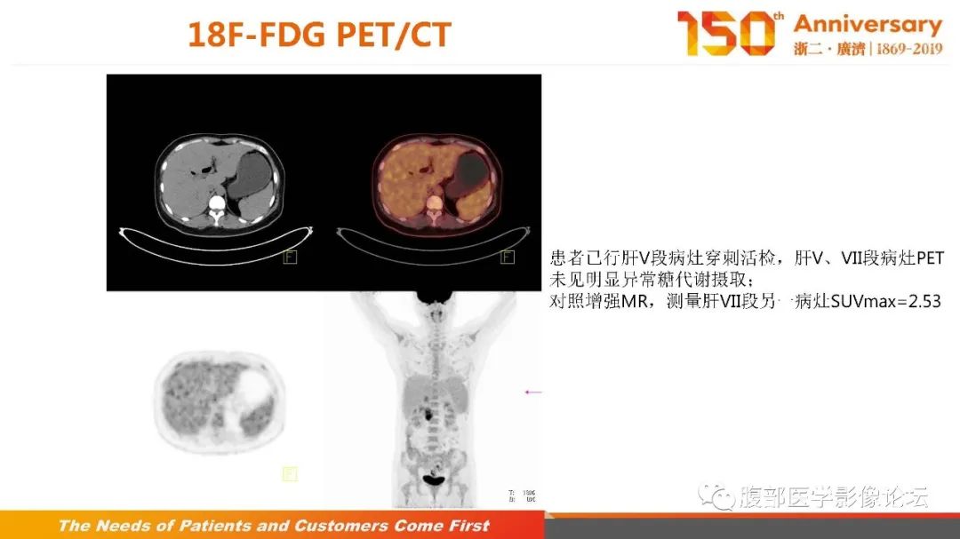 影像PPT - 【病例】胰腺、肝脏髓系肉瘤(绿色瘤)1例CT及MR影像-19 影像PPT - 【病例】胰腺、肝脏髓系肉瘤(绿色瘤)1例CT及MR影像-19