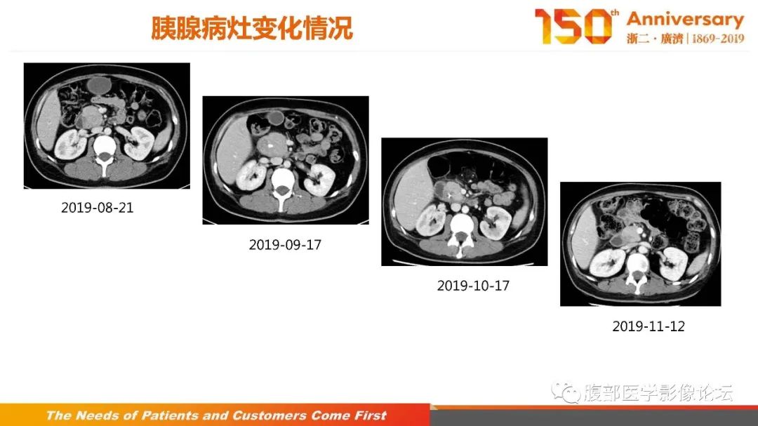 影像PPT - 【病例】胰腺、肝脏髓系肉瘤(绿色瘤)1例CT及MR影像-25 影像PPT - 【病例】胰腺、肝脏髓系肉瘤(绿色瘤)1例CT及MR影像-25