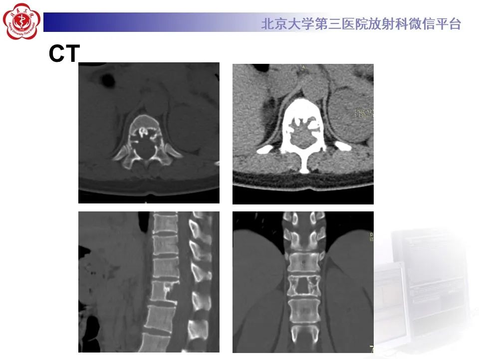影像PPT - 【PPT】脊柱良性转移性平滑肌瘤-3