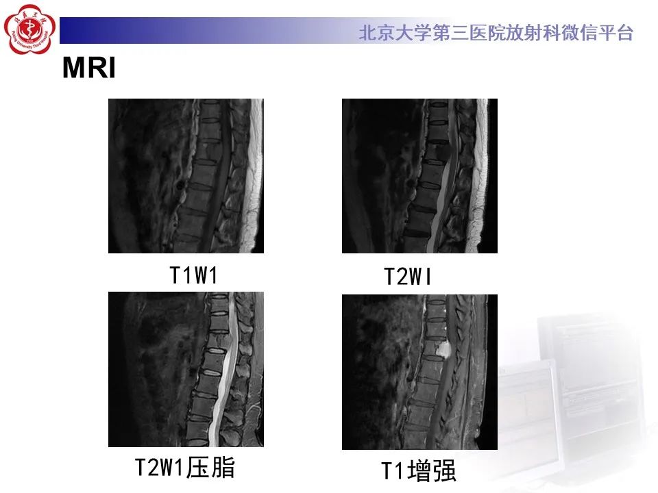影像PPT - 【PPT】脊柱良性转移性平滑肌瘤-4