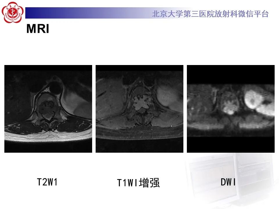 影像PPT - 【PPT】脊柱良性转移性平滑肌瘤-5