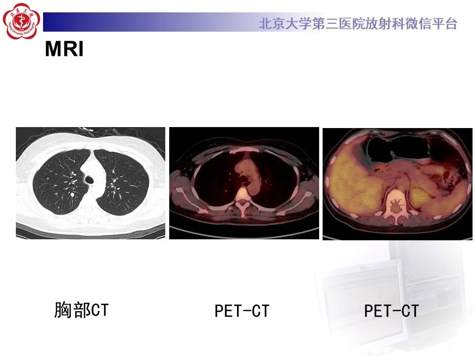 影像PPT - 【PPT】脊柱良性转移性平滑肌瘤-6