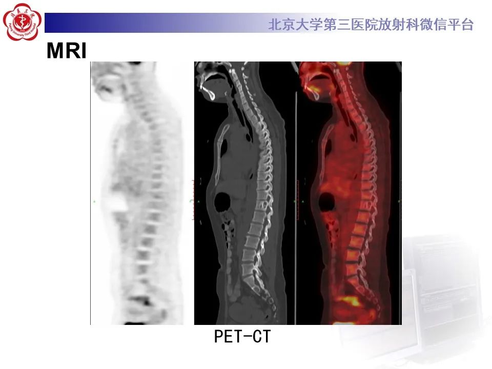 影像PPT - 【PPT】脊柱良性转移性平滑肌瘤-7