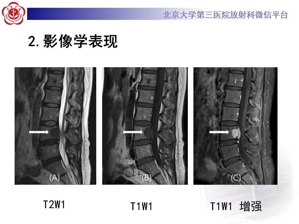 影像PPT - 【PPT】脊柱良性转移性平滑肌瘤-17