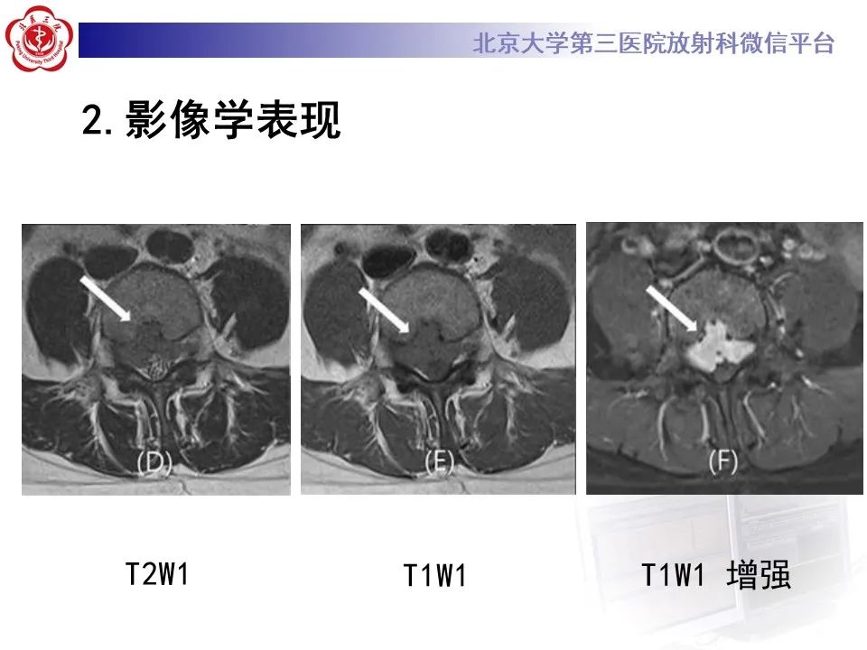 影像PPT - 【PPT】脊柱良性转移性平滑肌瘤-18