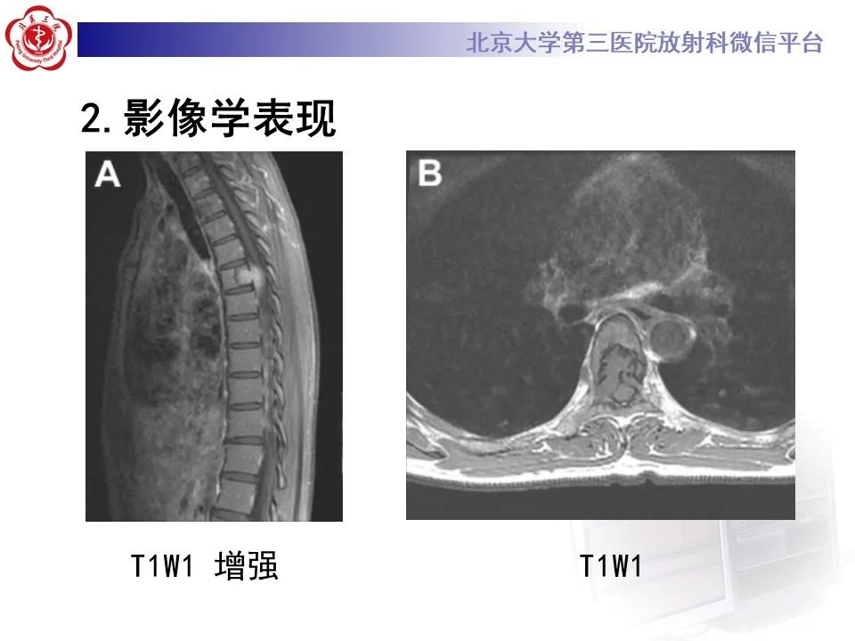 影像PPT - 【PPT】脊柱良性转移性平滑肌瘤-19