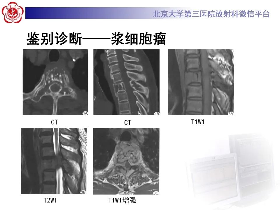 影像PPT - 【PPT】脊柱良性转移性平滑肌瘤-22