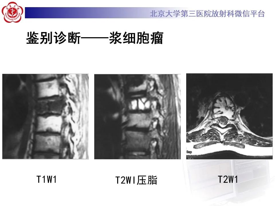 影像PPT - 【PPT】脊柱良性转移性平滑肌瘤-23