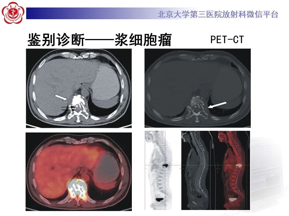 影像PPT - 【PPT】脊柱良性转移性平滑肌瘤-24