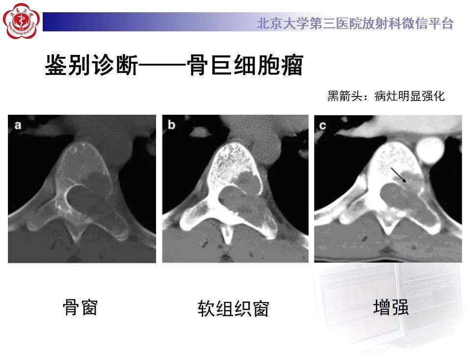 影像PPT - 【PPT】脊柱良性转移性平滑肌瘤-26