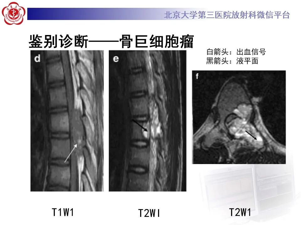 影像PPT - 【PPT】脊柱良性转移性平滑肌瘤-27