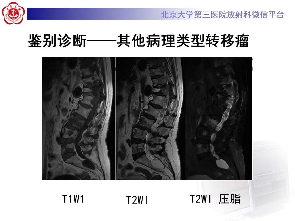影像PPT - 【PPT】脊柱良性转移性平滑肌瘤-29