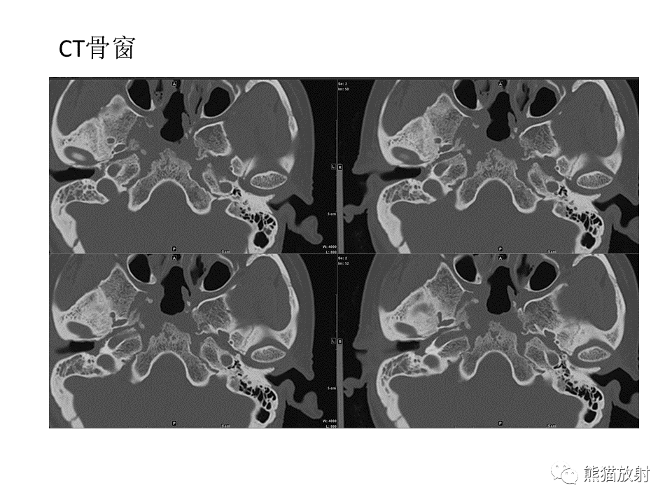 影像PPT - 【病例】鞍区脊索瘤VS淋巴瘤-3
