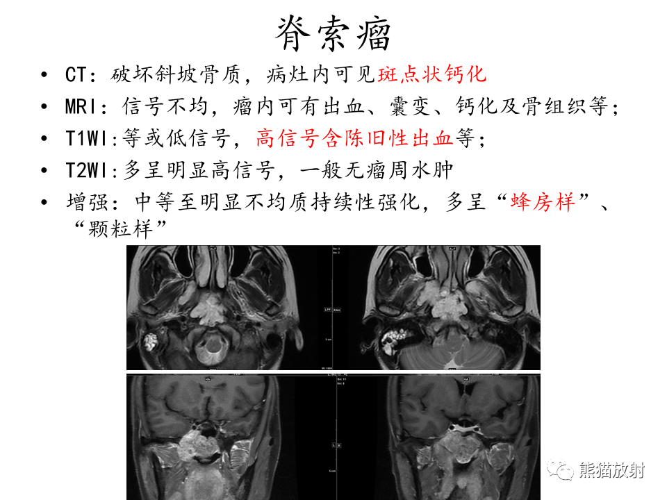 影像PPT - 【病例】鞍区脊索瘤VS淋巴瘤-25