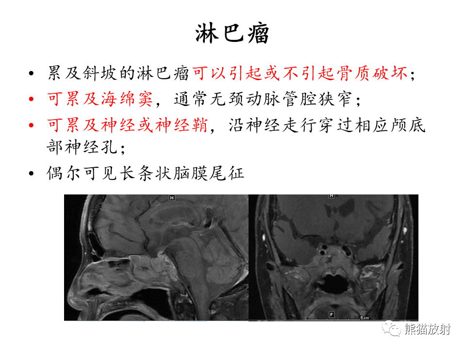 影像PPT - 【病例】鞍区脊索瘤VS淋巴瘤-26