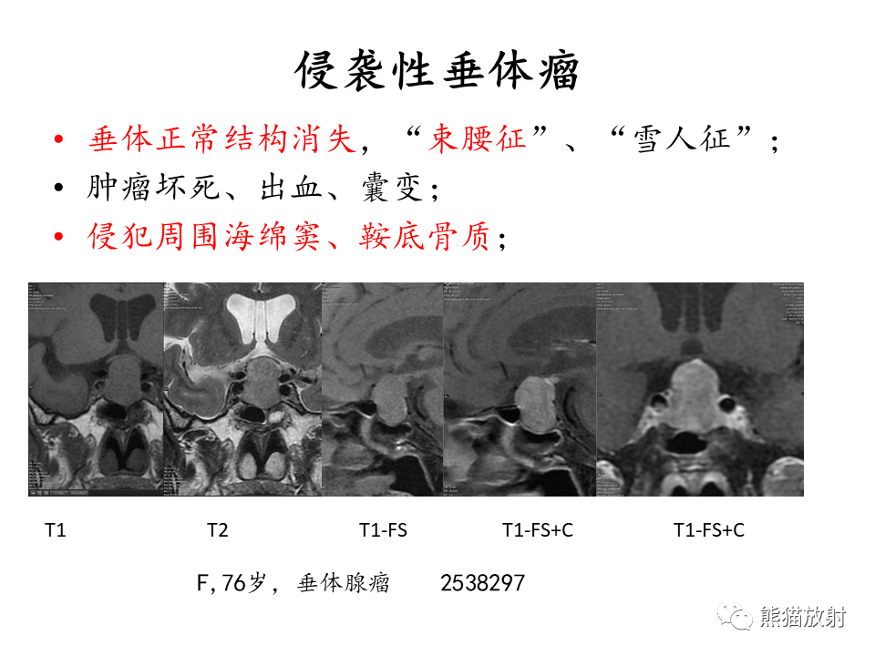 影像PPT - 【病例】鞍区脊索瘤VS淋巴瘤-27