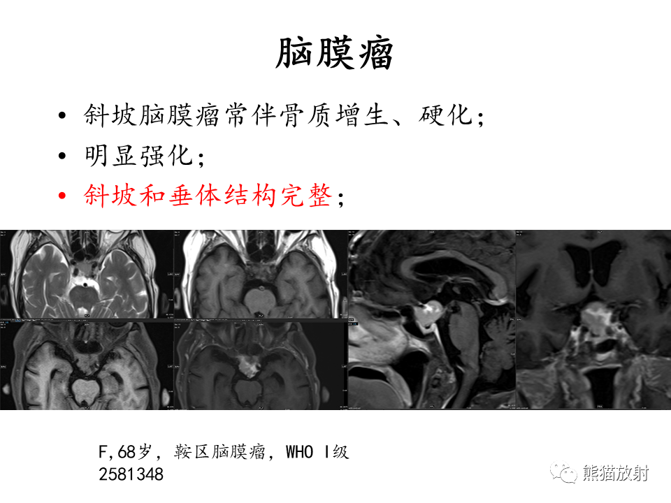 影像PPT - 【病例】鞍区脊索瘤VS淋巴瘤-28