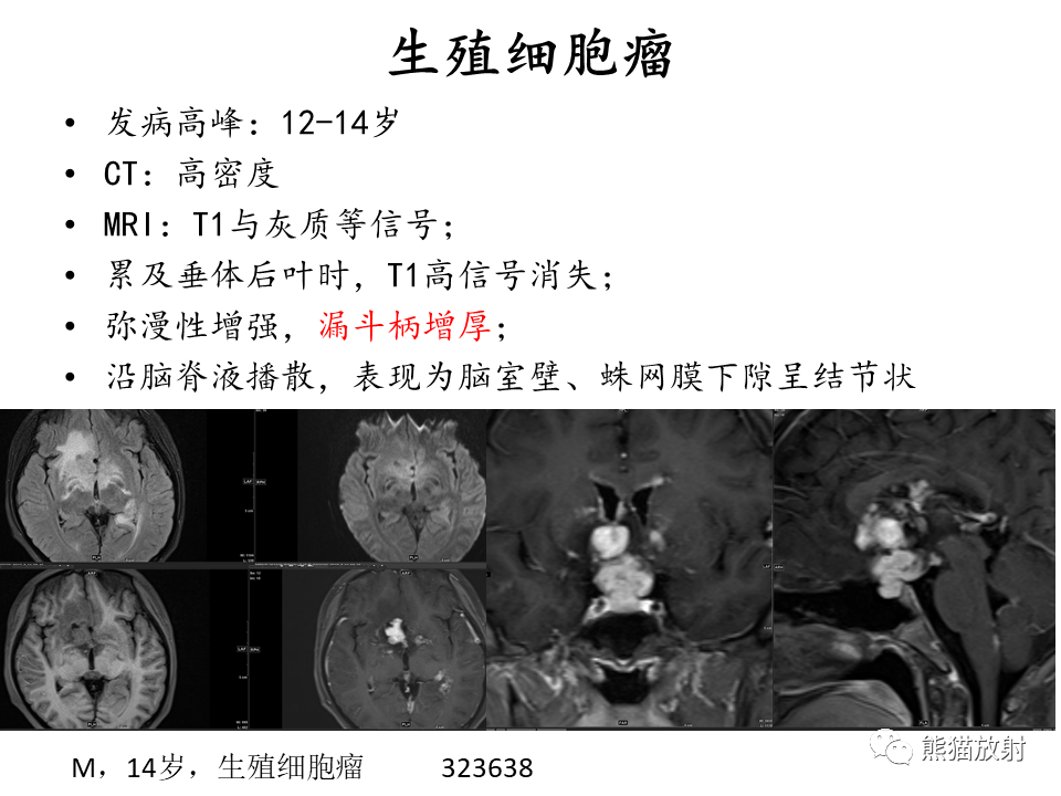 影像PPT - 【病例】鞍区脊索瘤VS淋巴瘤-29