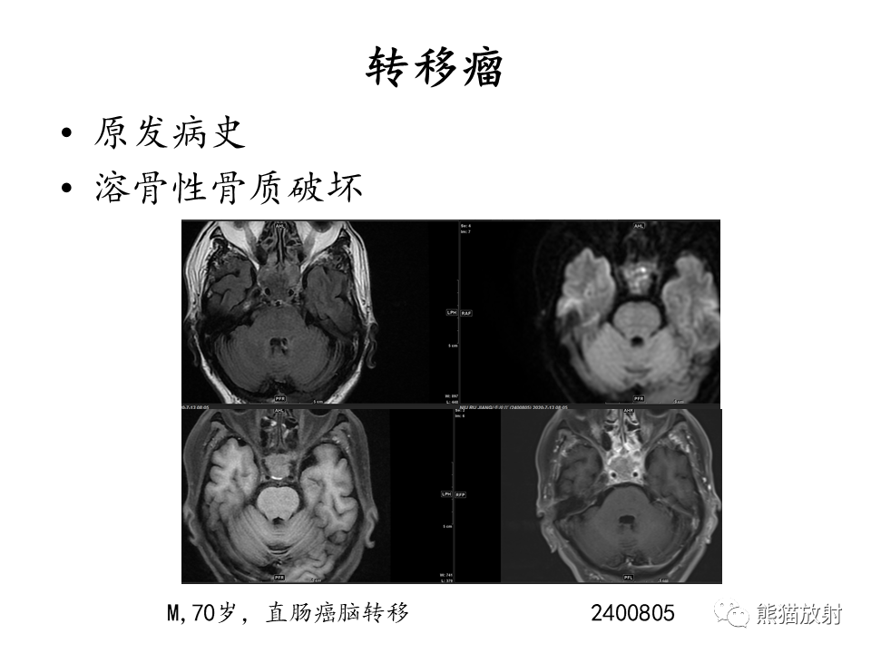 影像PPT - 【病例】鞍区脊索瘤VS淋巴瘤-30