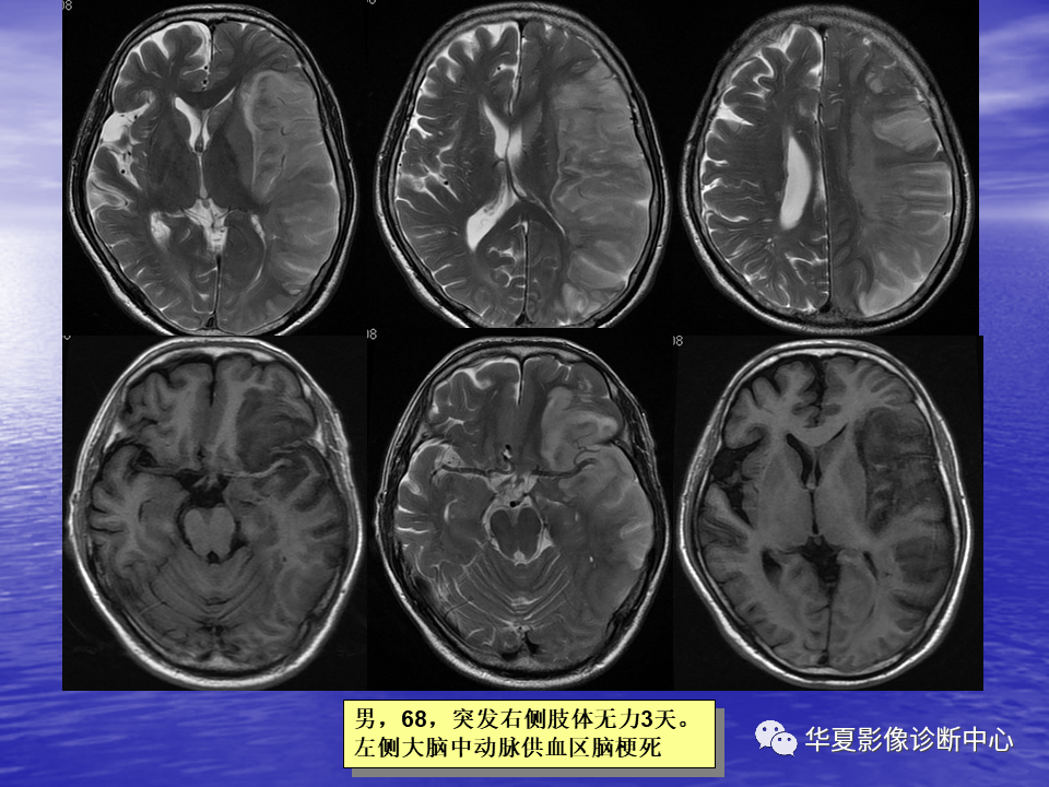 影像PPT - 【PPT】脑血管病变的MRI-6