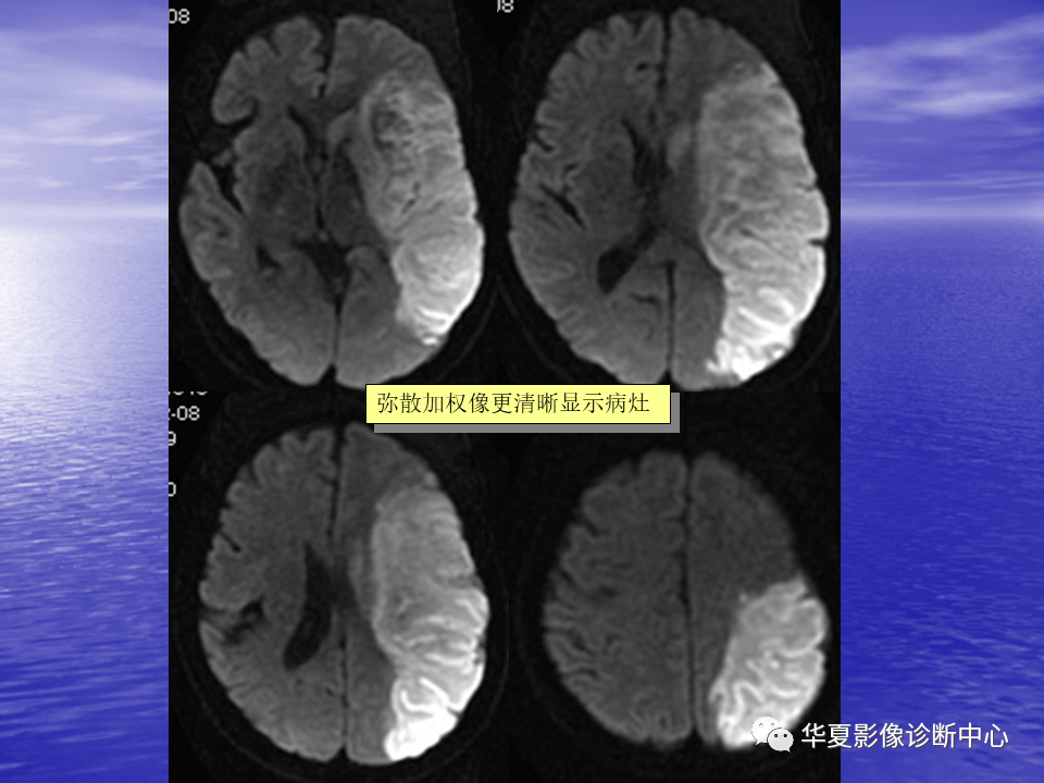 影像PPT - 【PPT】脑血管病变的MRI-7