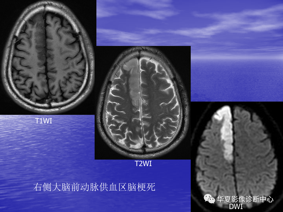 影像PPT - 【PPT】脑血管病变的MRI-8