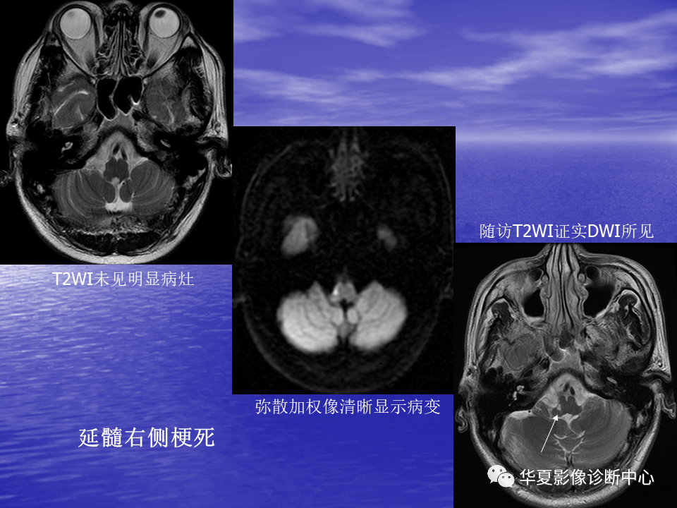 影像PPT - 【PPT】脑血管病变的MRI-9