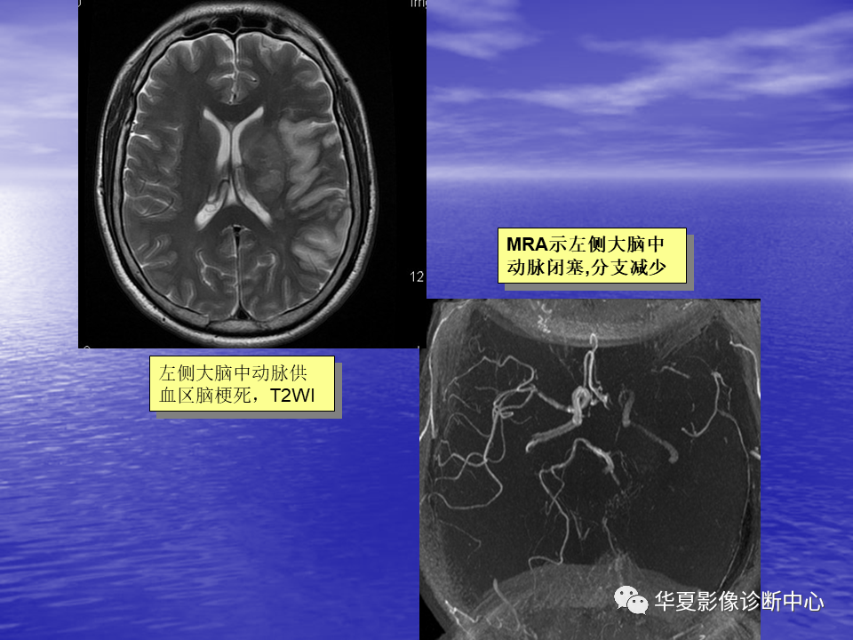 影像PPT - 【PPT】脑血管病变的MRI-10