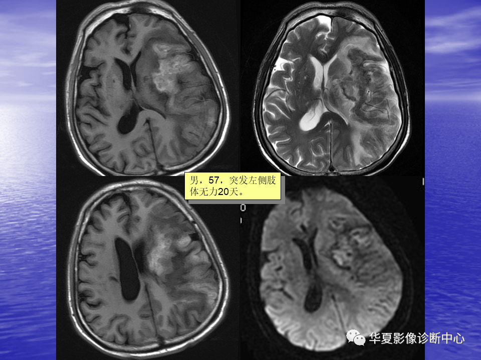 影像PPT - 【PPT】脑血管病变的MRI-12