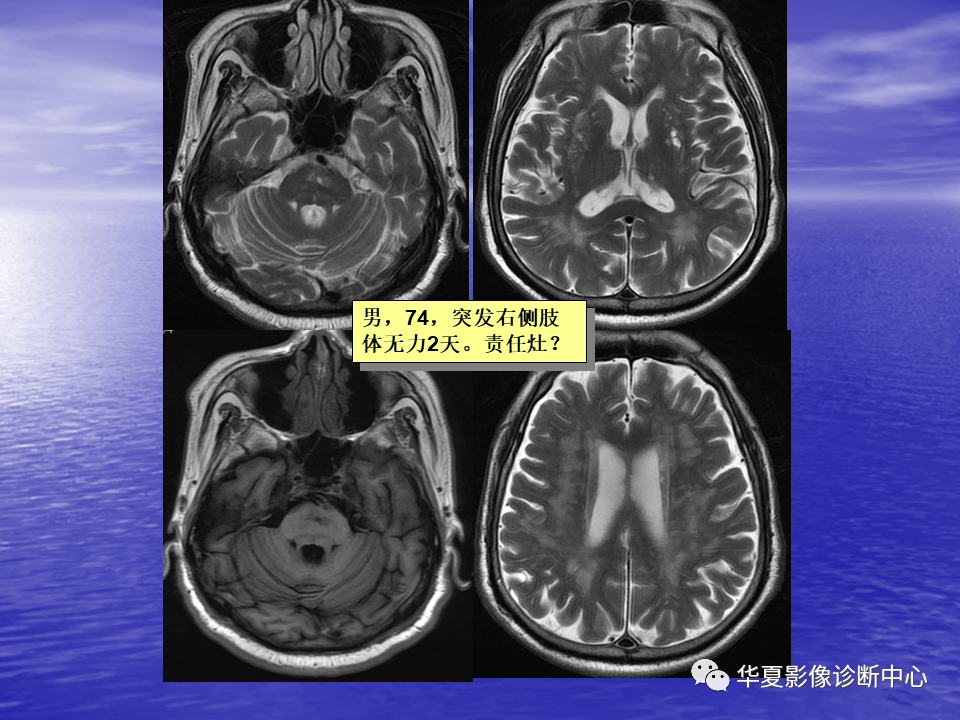 影像PPT - 【PPT】脑血管病变的MRI-14