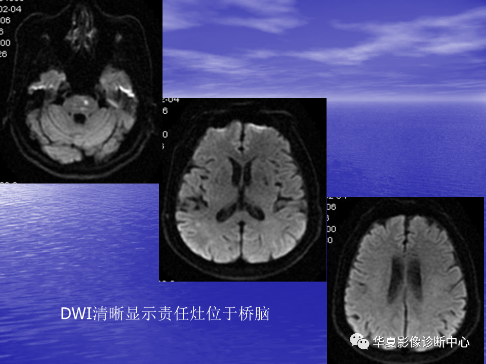 影像PPT - 【PPT】脑血管病变的MRI-15