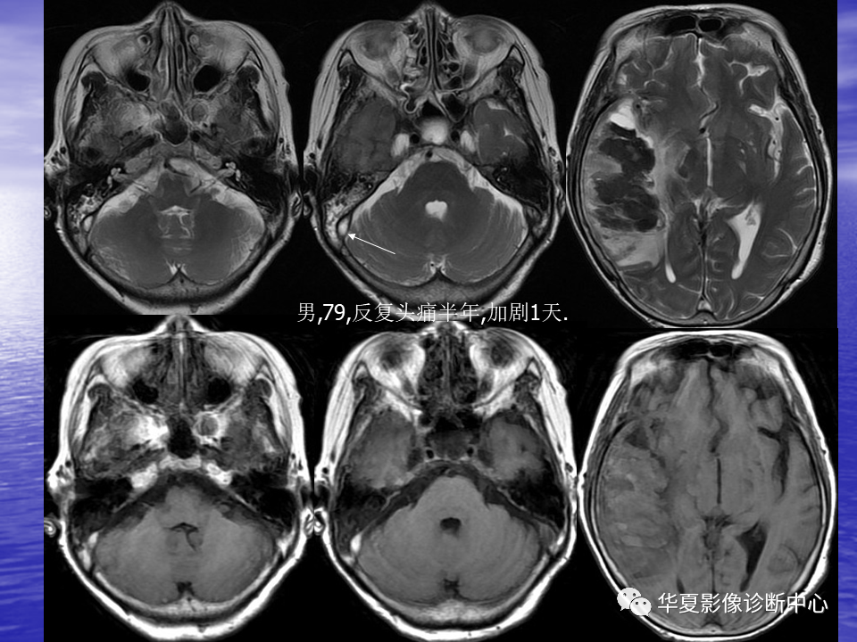 影像PPT - 【PPT】脑血管病变的MRI-17