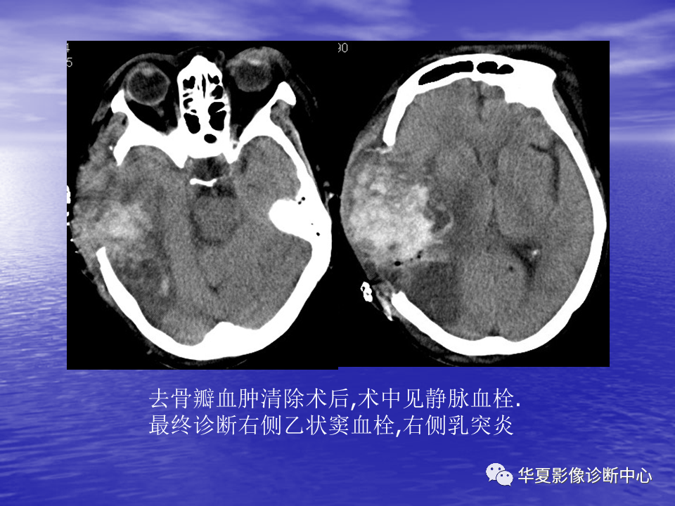 影像PPT - 【PPT】脑血管病变的MRI-18