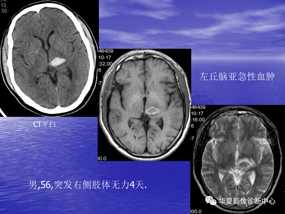 影像PPT - 【PPT】脑血管病变的MRI-21